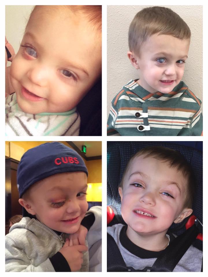 Jax's New Eye